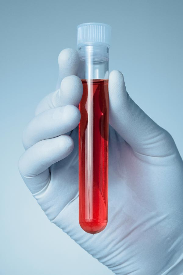 Autoimmune-Treatment Close up of a gloved hand holding a vial of red liquid, representing Thrive Family Practice & Med Spa's comprehensive autoimmune disorder treatment in Statesboro.