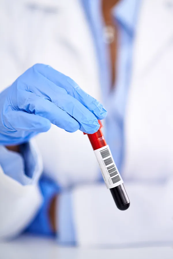High-Cholesterol-Treatment Close-up of a gloved clinician holding a blood test. Get treatment for high cholesterol from Thrive Family Practice & Med Spa in Statesboro.