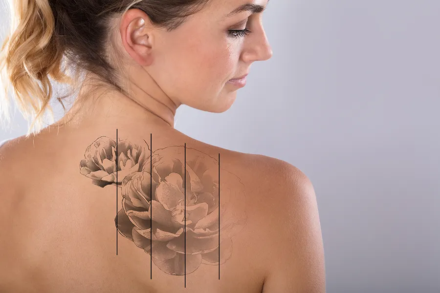 Tattoo-Removal-Clinic A woman bears her back and shows a tattoo with gradations of the removal process. Get tattoo removal services from Thrive Family Practice & Med Spa in Statesboro.
